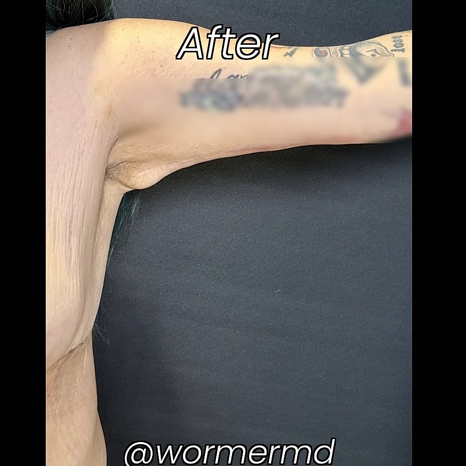 After Weight Loss Surgery Before & After
