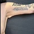 After Weight Loss Surgery Before & After