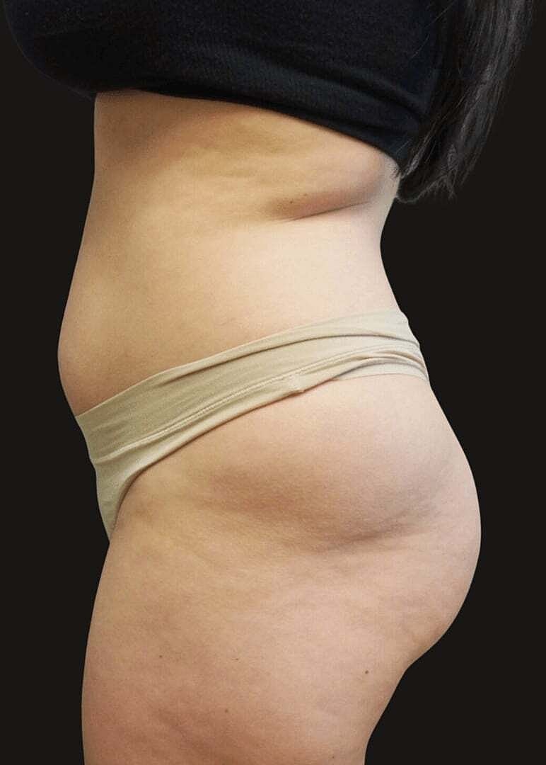 Brazilian Butt Lift Before & After
