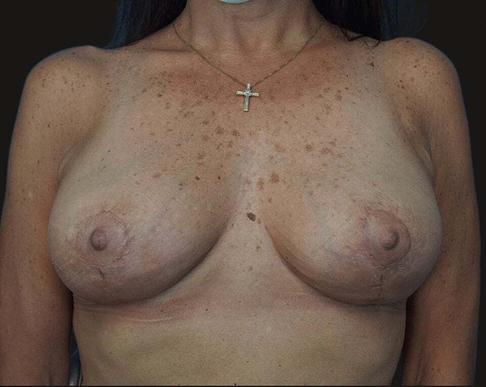 Breast Reduction And Lift Before & After