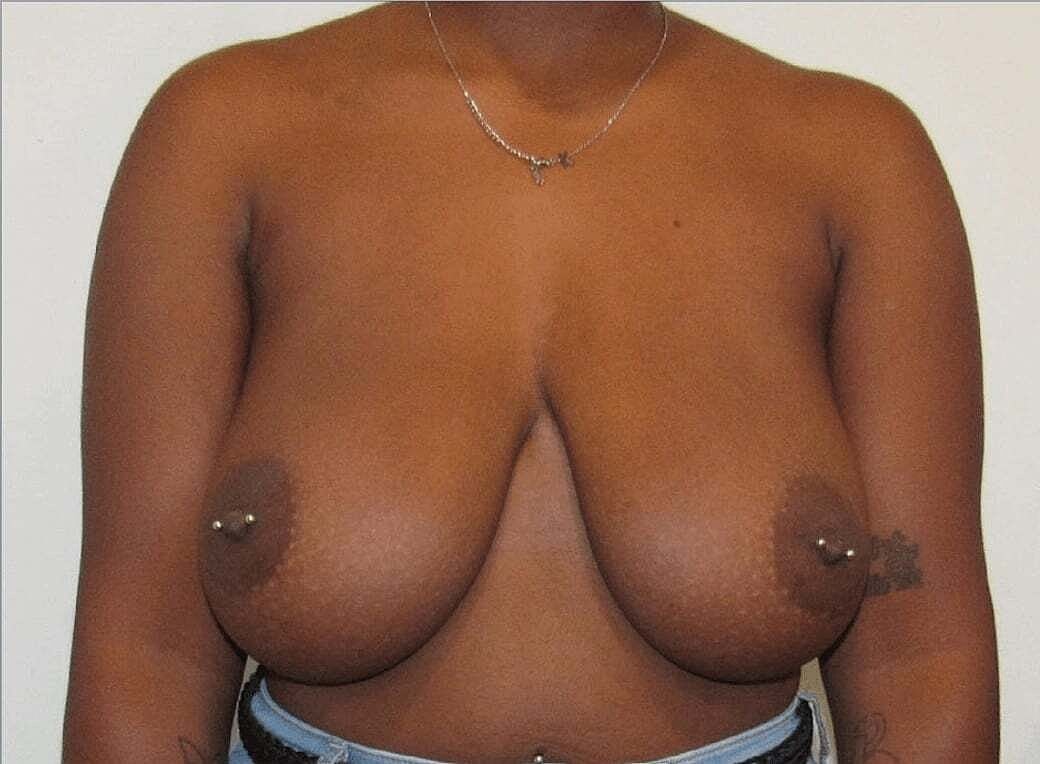 Breast Reduction And Lift Before & After