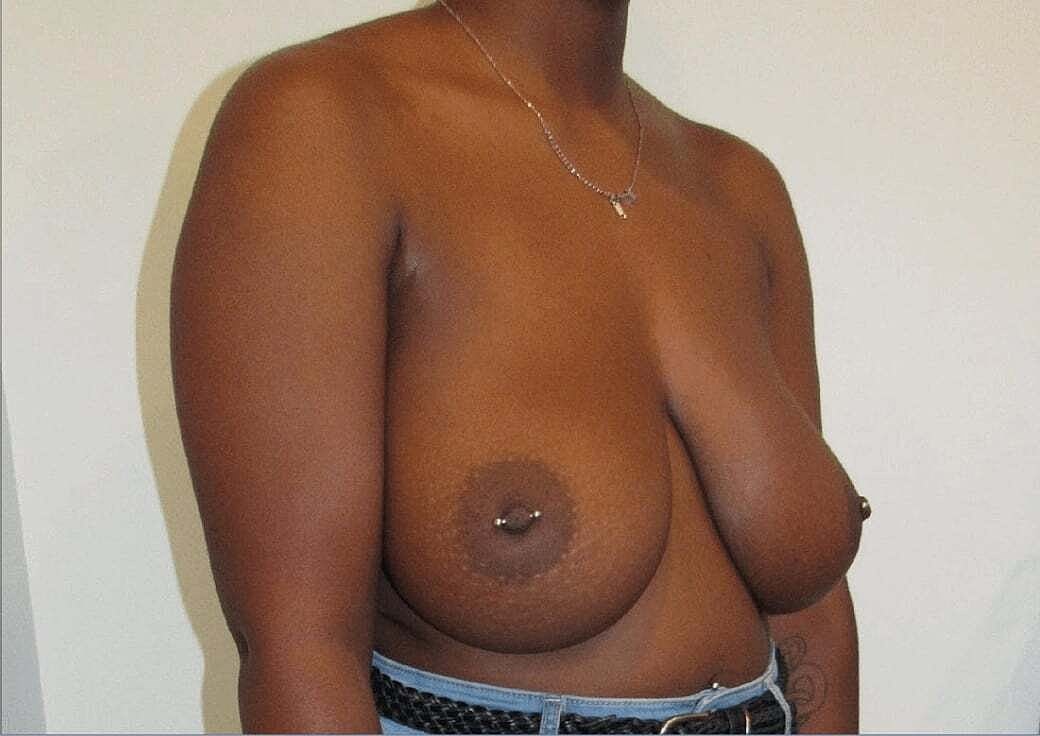 Breast Reduction And Lift Before & After