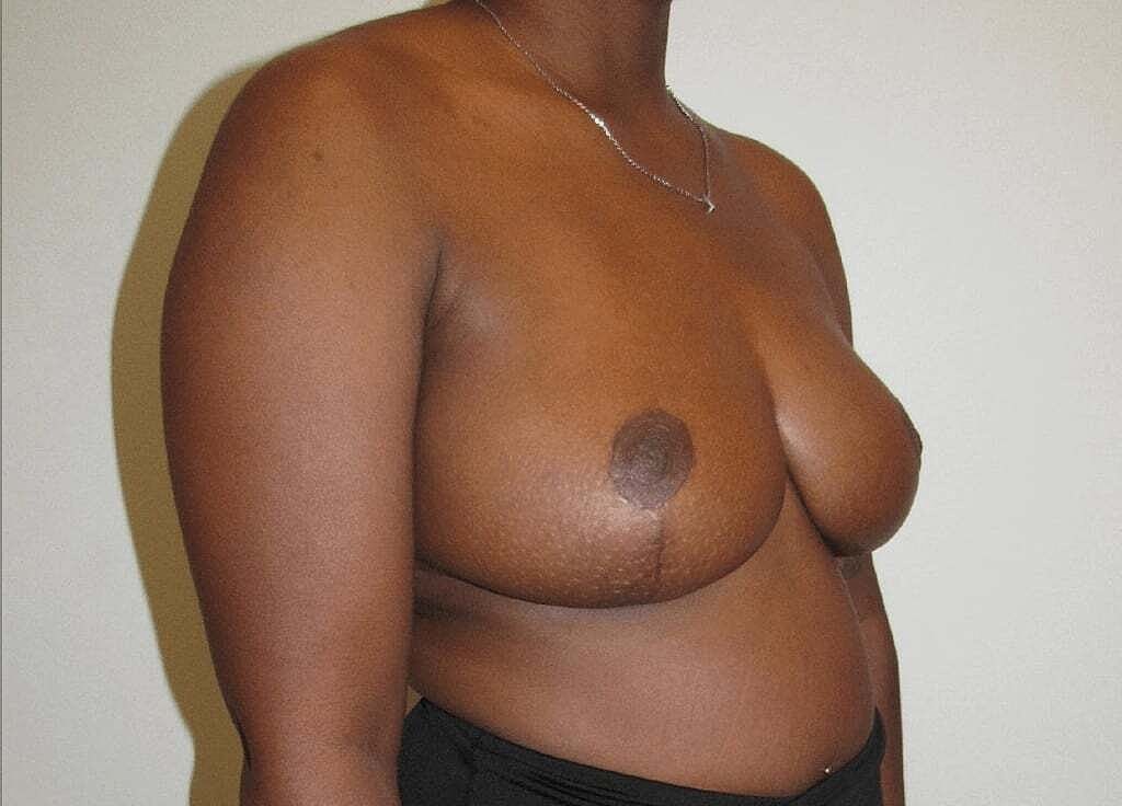 Breast Reduction And Lift Before & After