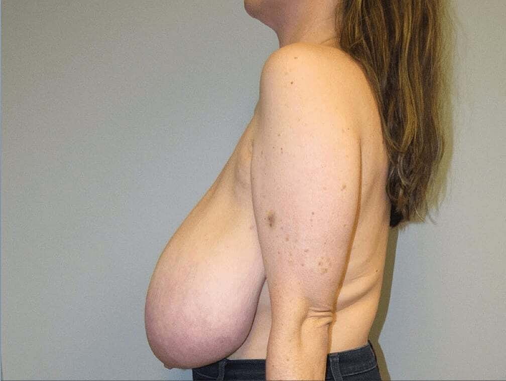Breast Reduction And Lift Before & After
