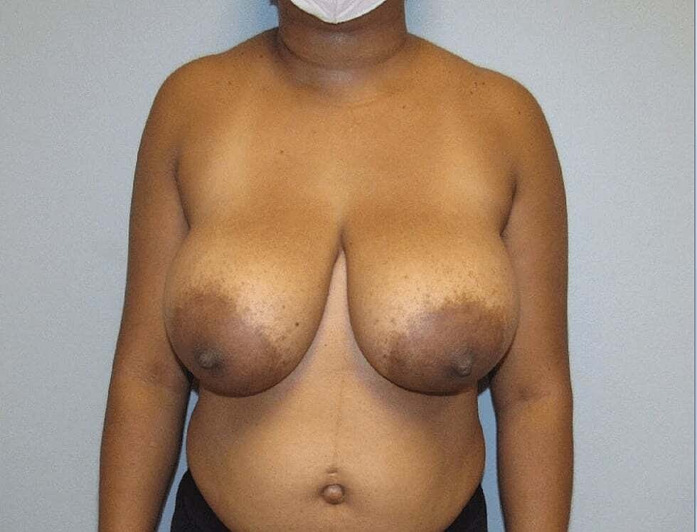 Breast Reduction And Lift Before & After