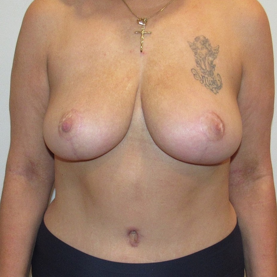 Breast Reduction And Lift Before & After